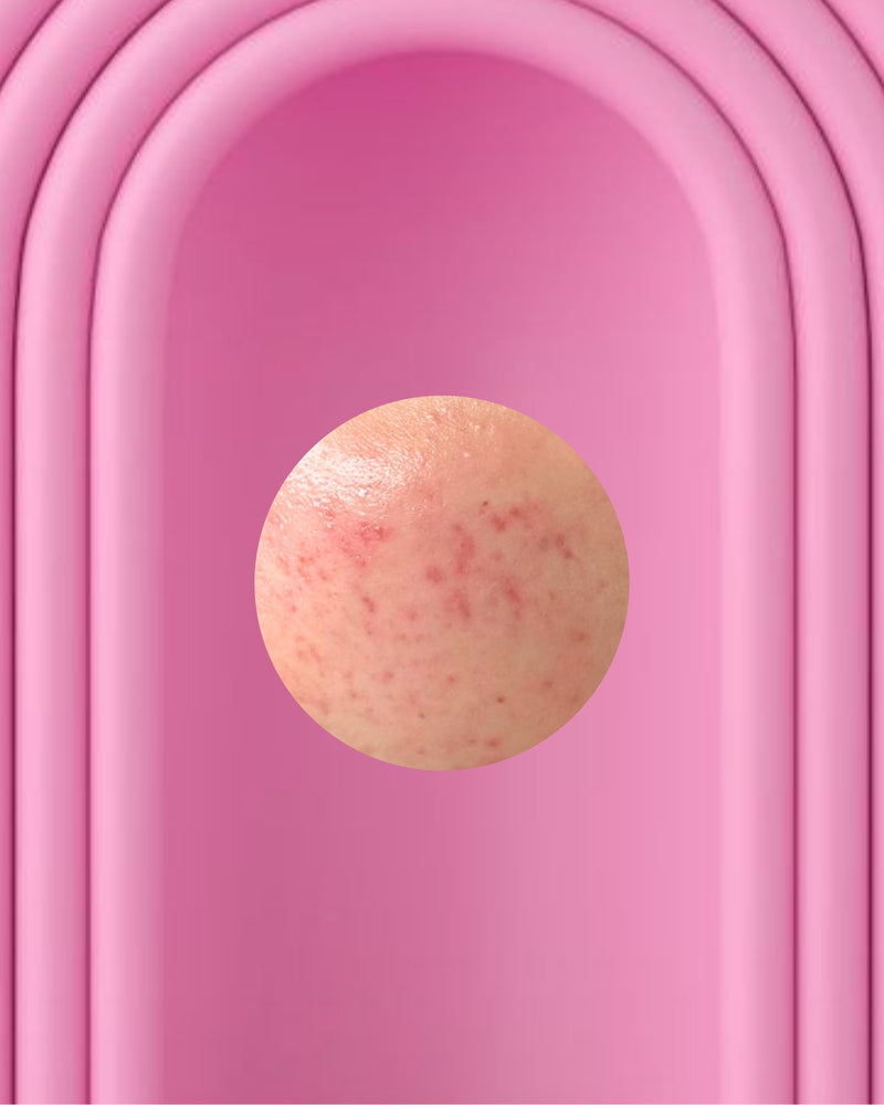 Po aknės likusi pigmentacija