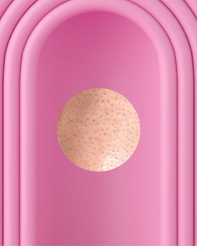 Užsikimšusios poros / Inkštirai